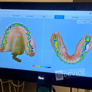 iTero Lumina Pro Intraoral Scanner