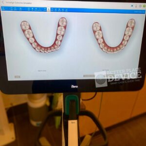 iTero Lumina Pro Intraoral Scanner