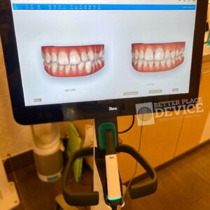 iTero Lumina Pro Intraoral Scanner